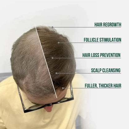 HAIR RESTORATION SYSTEM (90 DAY)