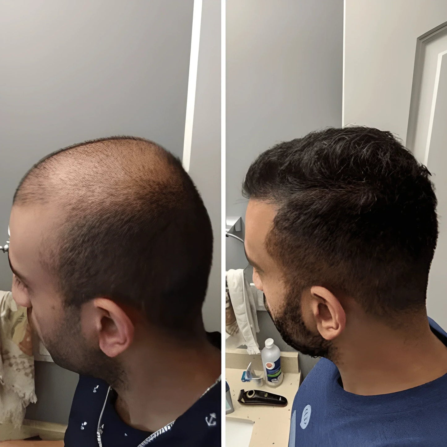 HAIR RESTORATION SYSTEM